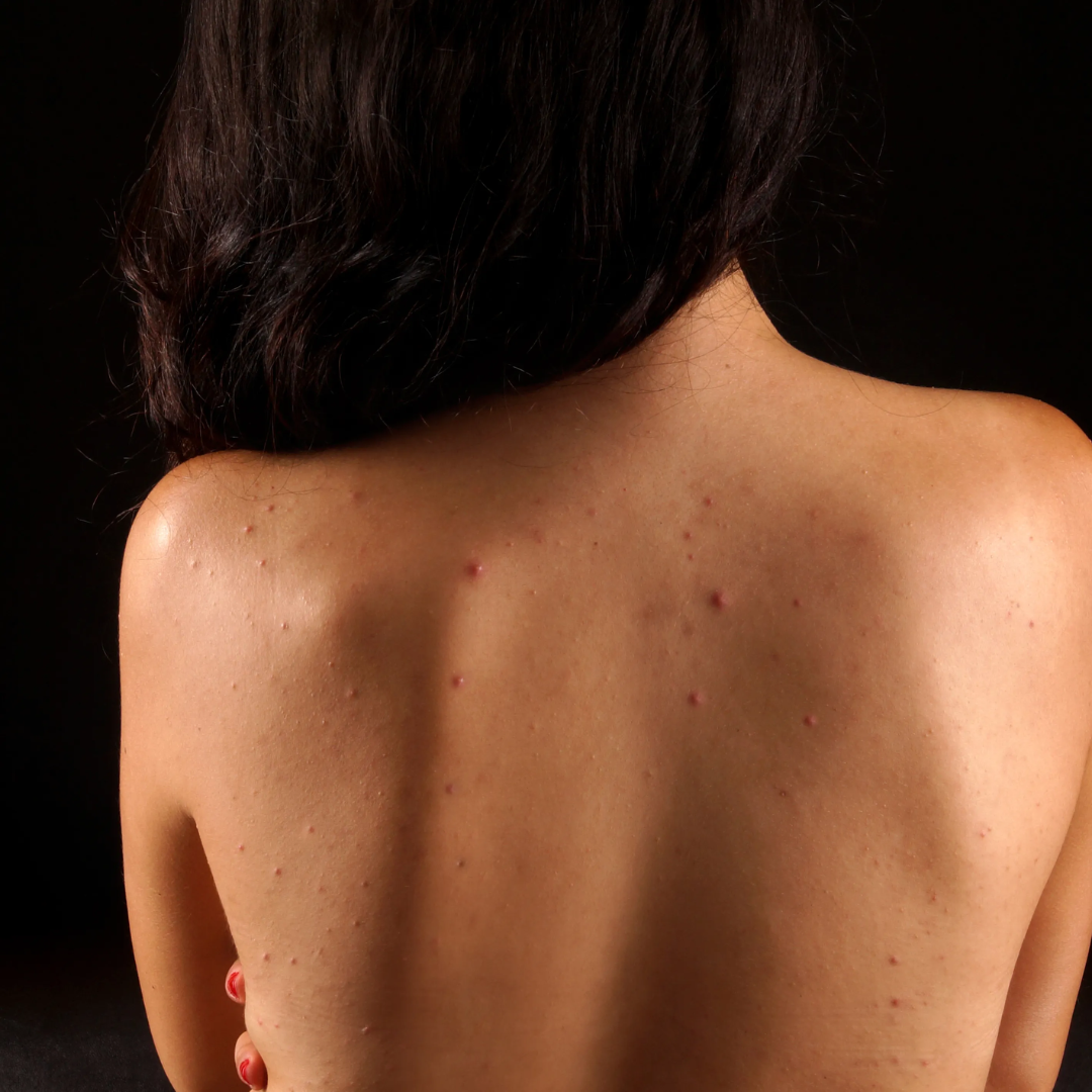 The Mineraw - Body Acne