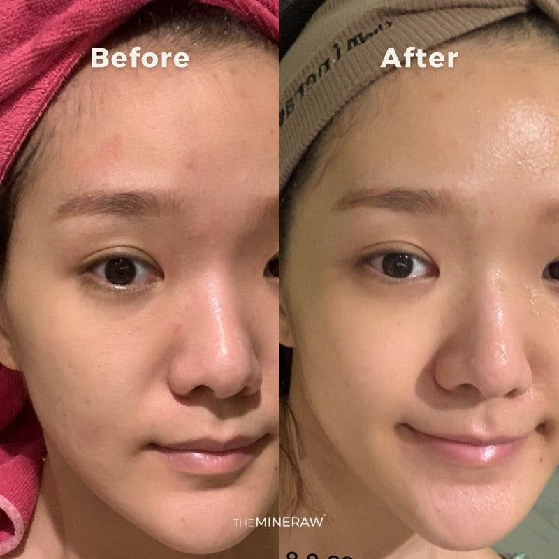 the mineraw glow serum face oil natural skincare malaysia kuala lumpur jojoba oil rosehip oil tea tree acne skin oily
