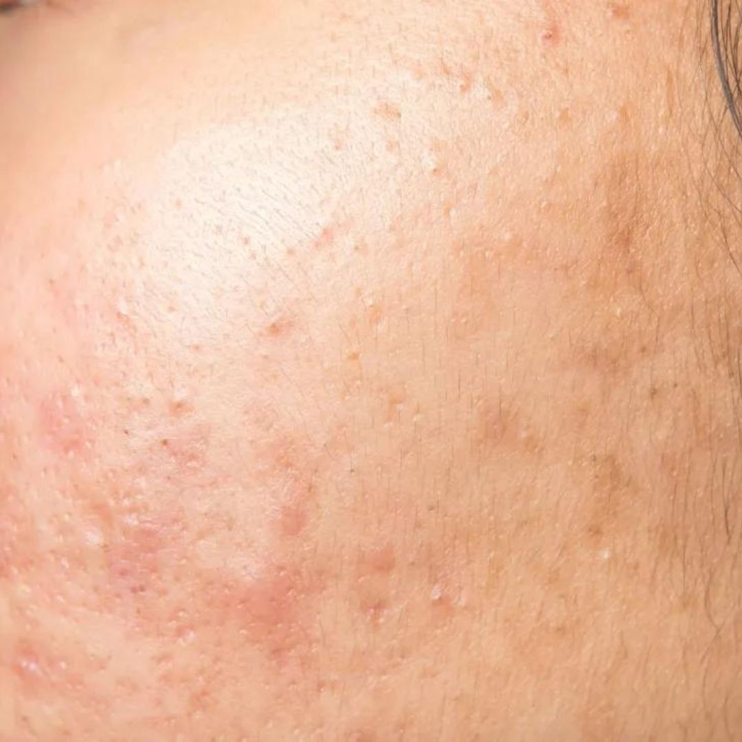 Skin Purging - It's not all bad – The Mineraw