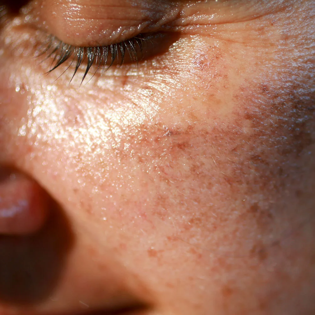 Hyperpigmentation